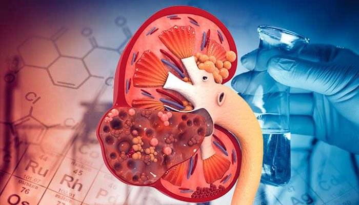 Bệnh thận là gì? nguyên nhân và các bệnh về thận