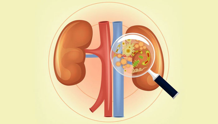 Viêm bể thận là gì?